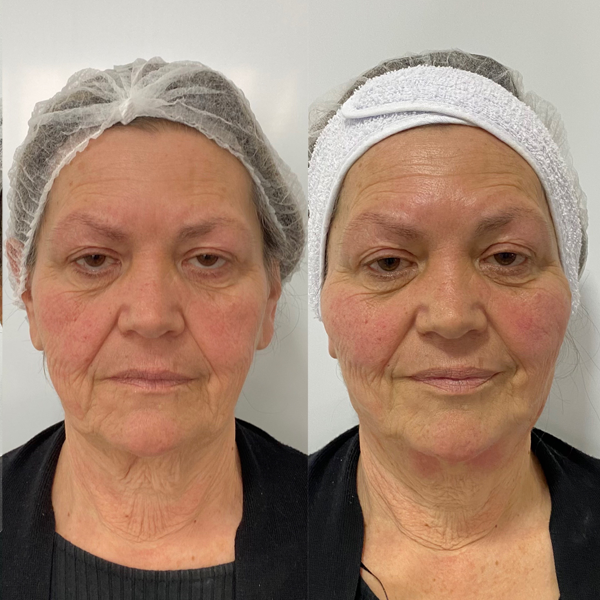 Antes-e-depois-de-Harmonização-Facial-Atrattiva-Estética-Clinica-de-estética-em-curitiba-21
